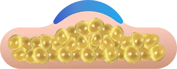 Illustration of an applicator drawing in the fat layer for CoolSculpting fat freezing in Dublin