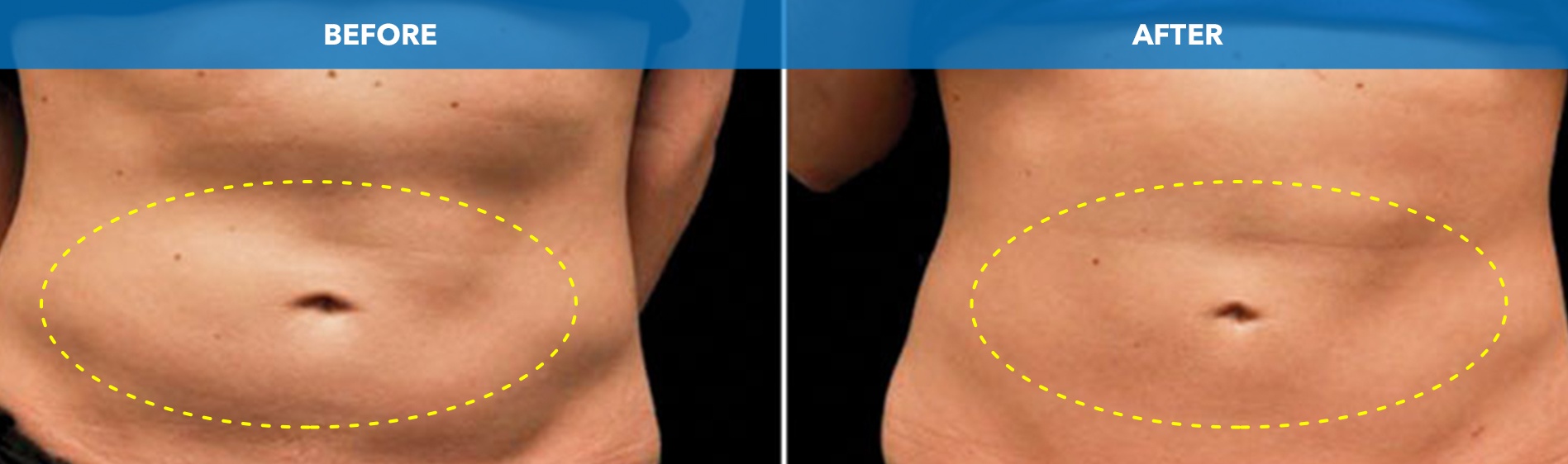 Abdomen before and after CoolSculpting fat freezing at Cool Clinic in Dublin